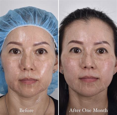 Thread Lift Sydney - #1 Cosmetic Doctors Face - Neck & Cheek Lift ...