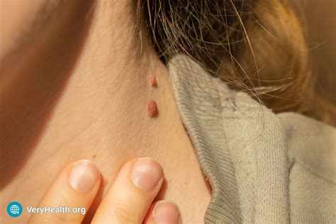 What Skin Tags Really Mean: Causes, Risks, and When to See a Doctor