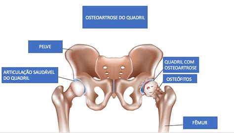 O Que É Artrose No Quadril - Artrose de Quadril | Ortocity | Clínica Ortopédica e de Reabilitação em ...