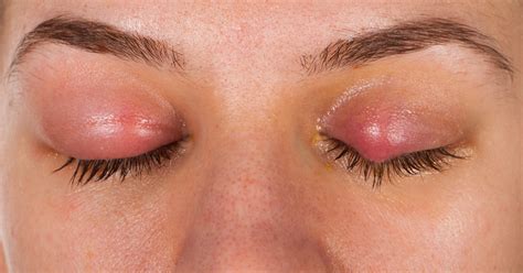 Eye Infection Treatment: What Works and What Doesn't