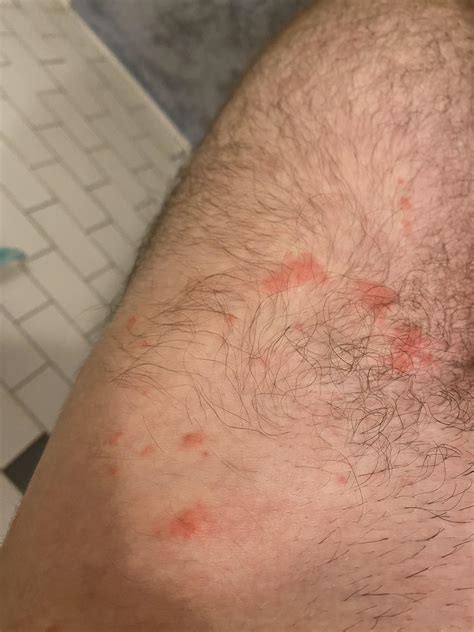 What’s causing my hives? : r/Dermatology