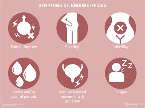 endometriosis symptoms infographic detailed vector  vrogueco