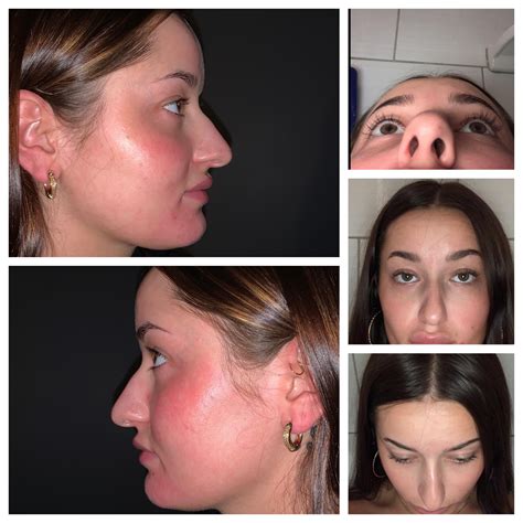 nose job  deviated septum  absolutely hate  nose