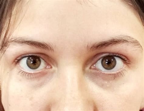 Один Глаз Меньше Другого Фото – Telegraph