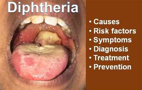 diphtheria explained  africans