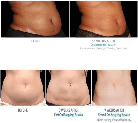 CoolSculpting - ELENA OCHER MEDICAL