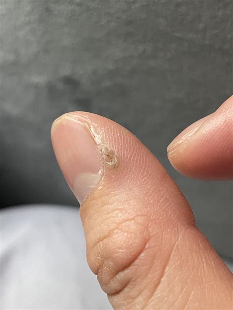 Thick skin on edge of thumb : r/DermatologyQuestions