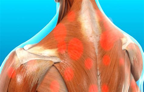myofascial trigger pain affecting  trapezius muscle el paso tx