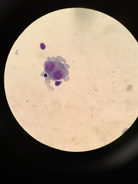 Malignant neoplasm of brain : r/medlabprofessionals