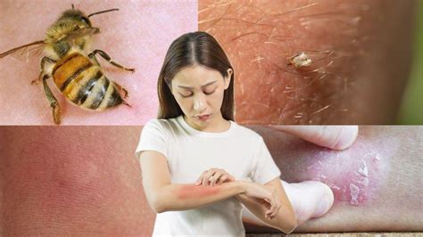 Effective Remedies For Bee Sting Pain: Relieve It Quickly #1
