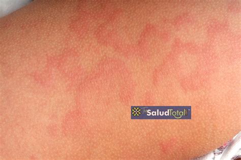 Alergia A Uva Roxa Sintomas - Alergias Alimentarias: ¡Síntomas y Desencadenantes!