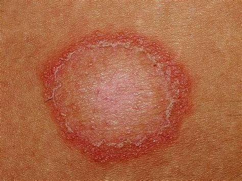 Ringworm in babies causes, signs, symptoms, diagnosis & treatment