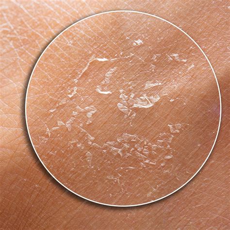 Closeup texture of dry human skin peeling off | Premium Photo