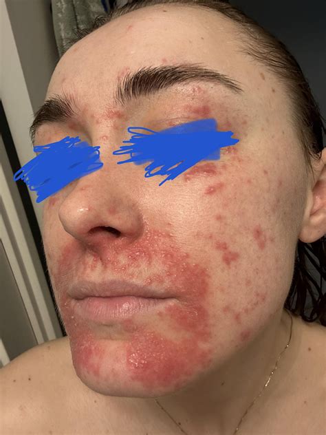 Desperate for help with my granulomatous rosacea : r/Rosacea
