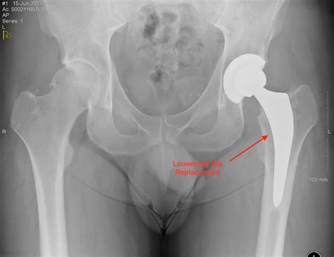 Revision Hip Surgery – Knee and Hip Website