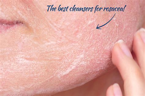 rosacea cleansers