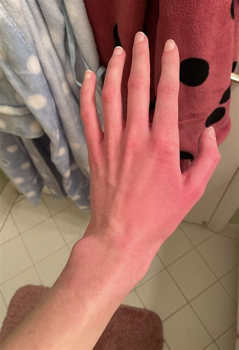 Facial erythromelalgia : r/Erythromelalgia