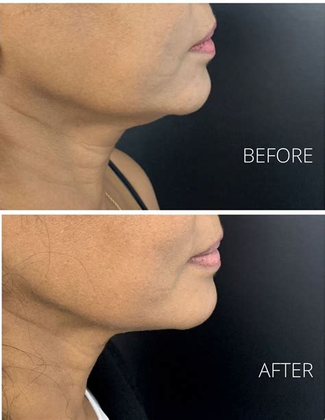 face lift jowls 9