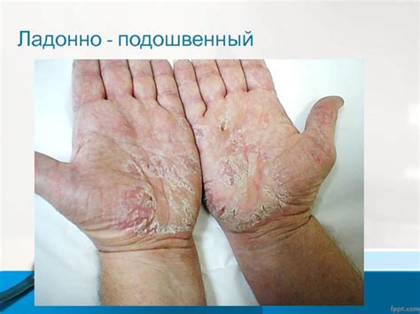 Псориаз. Виды псориаза презентация, доклад