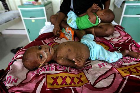 Stunted growth ‘and’ obesity: the double burden of poor nutrition on