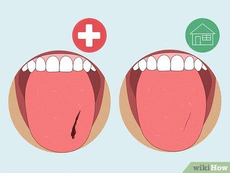 Língua Mordida Na Lateral - 4 Formas de Curar uma Língua Mordida - wikiHow