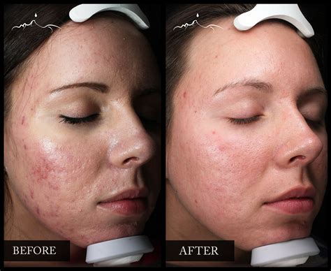 BBL Acne – Conklin Clinics