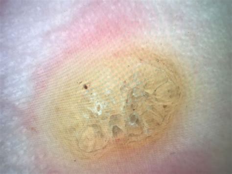 Лечение бородавок