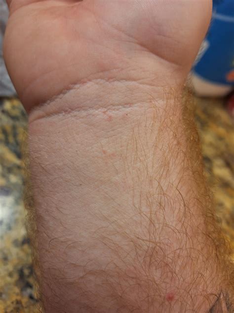 Possible allergic reaction? : r/DermatologyQuestions
