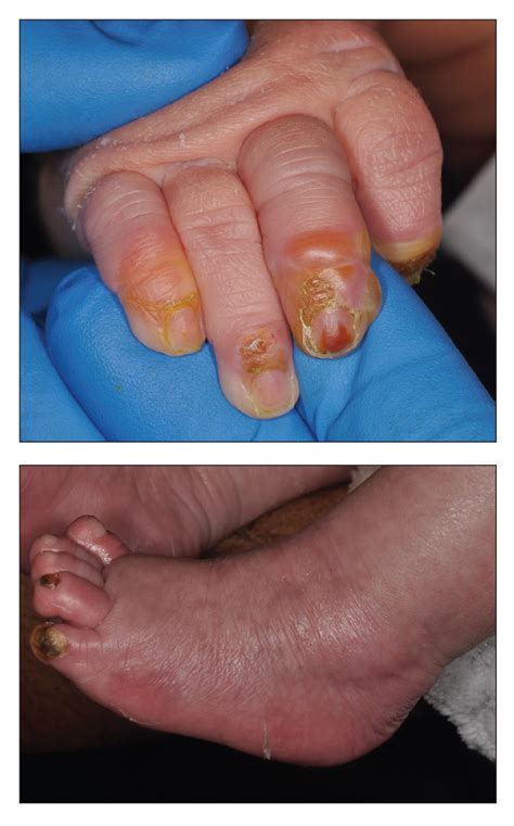 Bullous Impetigo Finger