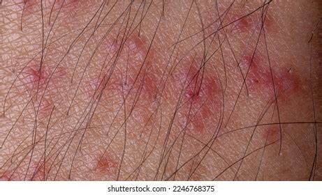 Tick Bite On Human Body Stock Photo 2246768375 | Shutterstock