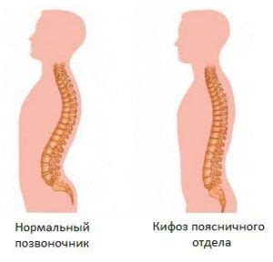 Кіфоз поперекового відділу хребта: лікування, фото - Київська лікарня ...