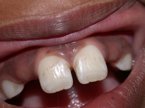 Clinical Cases « Welcome to Society for Oral Laser Application