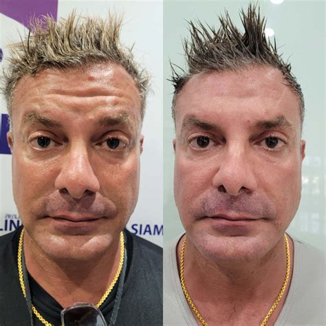 wrinkle reduction siam clinic thailand