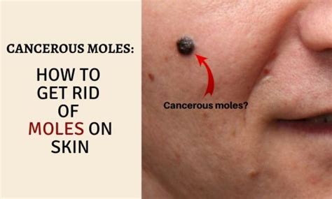 Cancerous moles: How to Get Rid of Moles on Skin