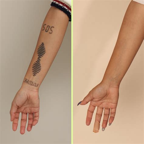 forearm tattoo removal