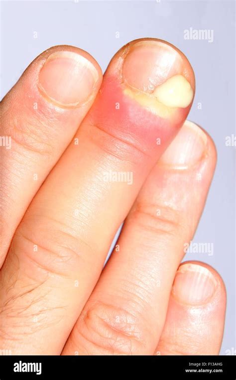 finger infection