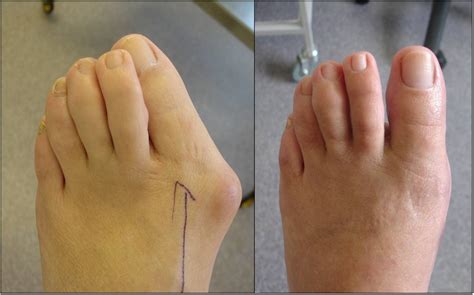 athletes   bunion surgery  martha presnell blog
