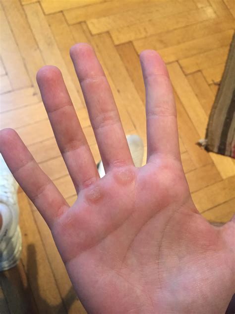 How to stop calluses on hands from gym? - MENSQUATS