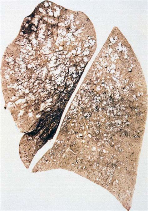 Centriacinar / Centrilobular emphysema