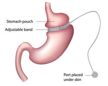 Lap-Band vs. Gastric Sleeve, Which Procedure is Right for Me?