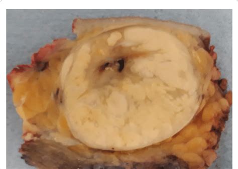 gross specimen  clear margins  scientific diagram