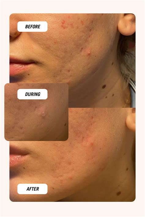 How to get rid of a pimple overnight – Common Clouds