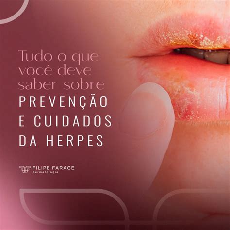 Passei Alho Na Herpes E Queimou - Dr - 🦠 A herpes é uma infecção viral comum que pode causar desconforto ...