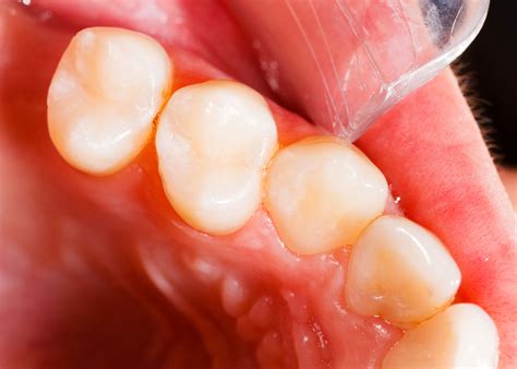 Tooth-Colored Fillings – Albuquerque, NM – Dr. James Slaman