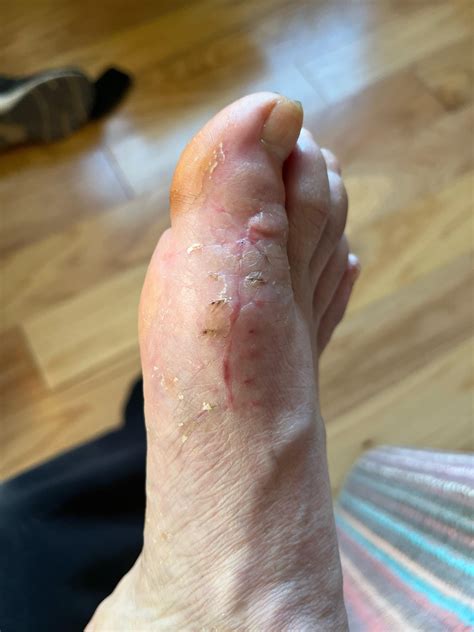 Skin care/comfort : r/bunions