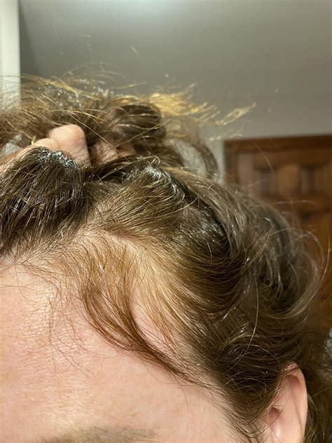 Two months off spiro and look at all these new hairs 🥹 : r/Spironolactone