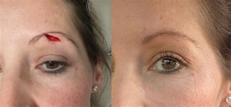 face burst skin injury acne scar florida