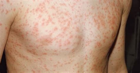 Escarlatina Quanto Tempo Dura - Escarlatina: o que é, sintomas e tratamento