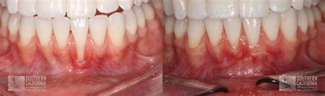 San Diego Gum Graft Before & After Photos | Tina Beck-Mayo, DDS