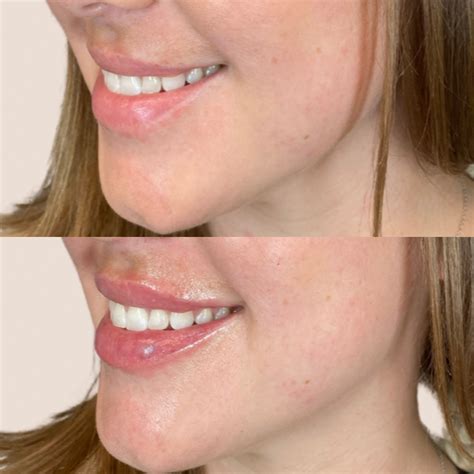 Lip Fillers in Scottsdale, AZ - Skin Savvy Aesthetics Med Spa